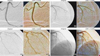 Optimizing ensemble U-Net architectures for robust coronary vessel segmentation in angiographic images