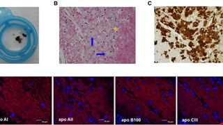 Detection of a High Ratio of Soluble to Membrane-Bound LOX-1 in Aspirated Coronary Thrombi from Patients with ST-elevation Myocardial Infarction