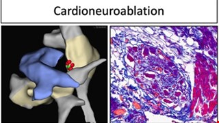 Ischemia-induced ventricular proarrhythmia and cardiovascular autonomic dysreflexia after cardioneuroablation