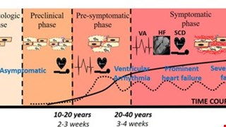 Pathogenesis of Arrhythmogenic Cardiomyopathy: Role of Inflammation