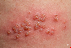 風濕病友的「蛇」影幢幢？