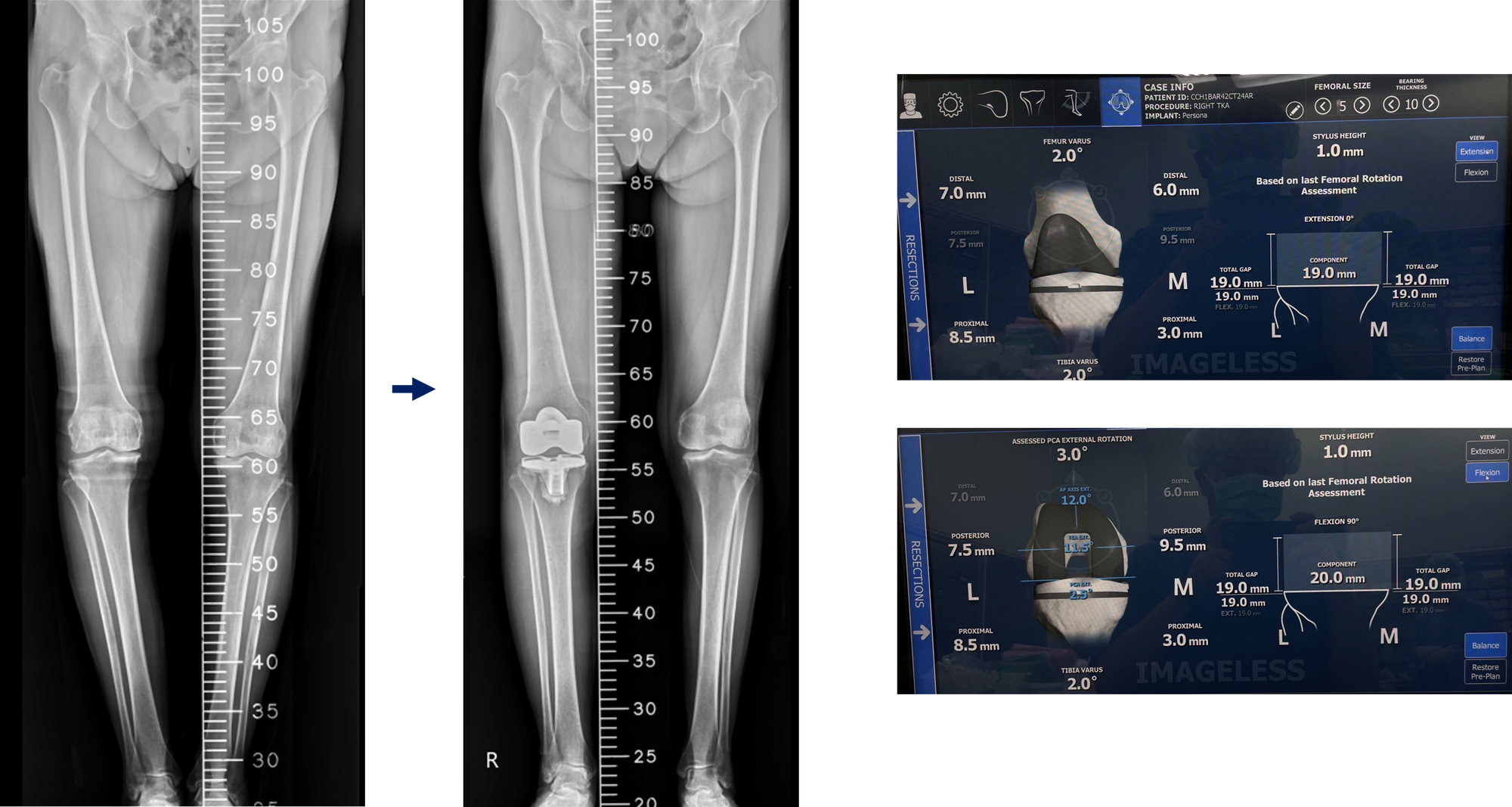 ROSA - Assisted Total Knee Arthroplasty - China Medical University Hospital