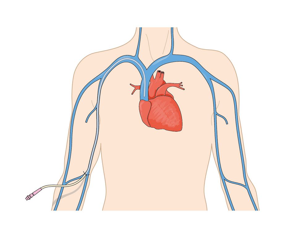 周边置入中心静脉导管(picc)换药与居家照护